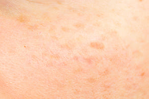 しみ・そばかす