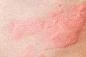 アトピー性皮膚炎