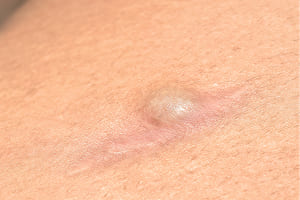 粉瘤・皮膚腫瘍